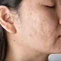 acne-scarring.webp