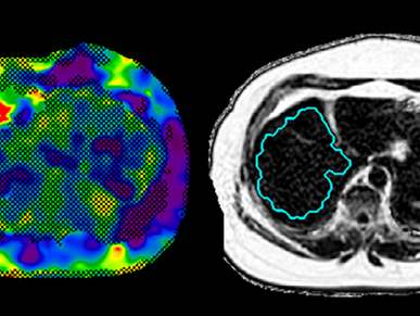Study: MRE has 0.87 AUROC for Diagnosing NASH