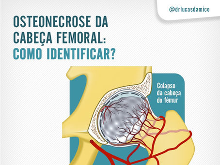 Osteonecrose da cabeça femoral: Como identificar?