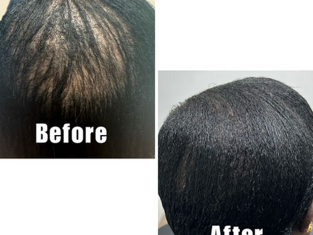 How Effective Are Follicle Stimulating Treatments for Hair Growth?