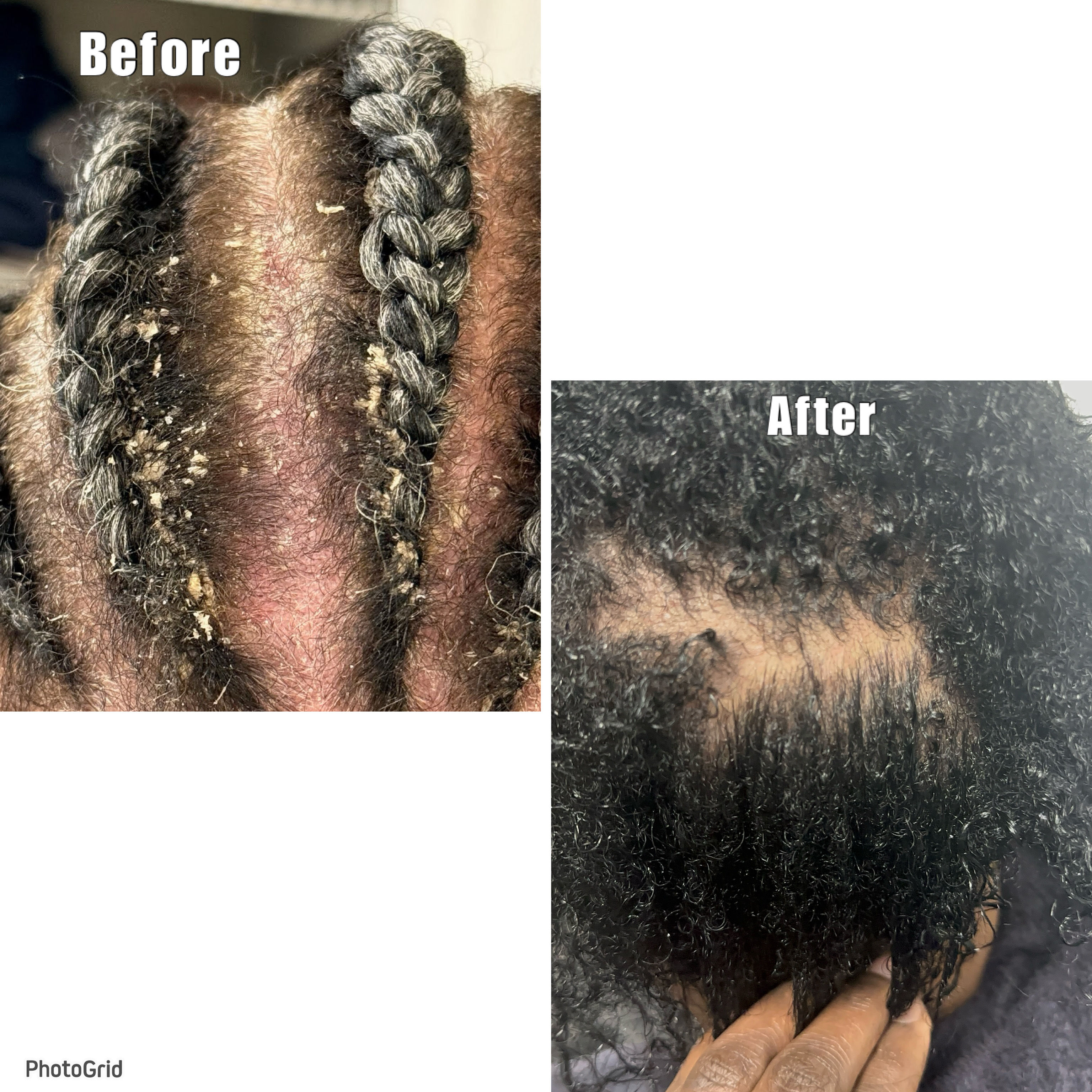 SCALP DISORDER