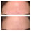 Thumbnail: Forehead Anti-Wrinkle Patch