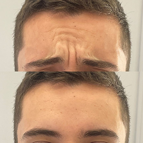 Resultado da Aplicação de Toxina Botulínica no Terço Superior (glabela) em Itajaí/SC