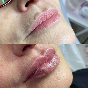 Resultado de Preenchimento Labial a base de Ácido Hialurônico em Itajaí/SC