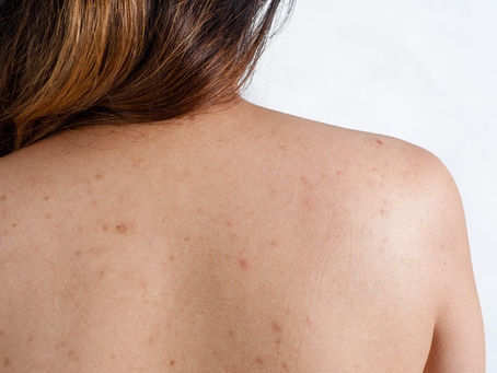 60. Therapist Thursday- Conversations with a Skin Expert: Back Acne