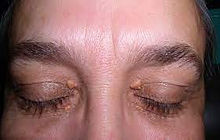 XANTHELASMA PALPEBRARUM.jpg