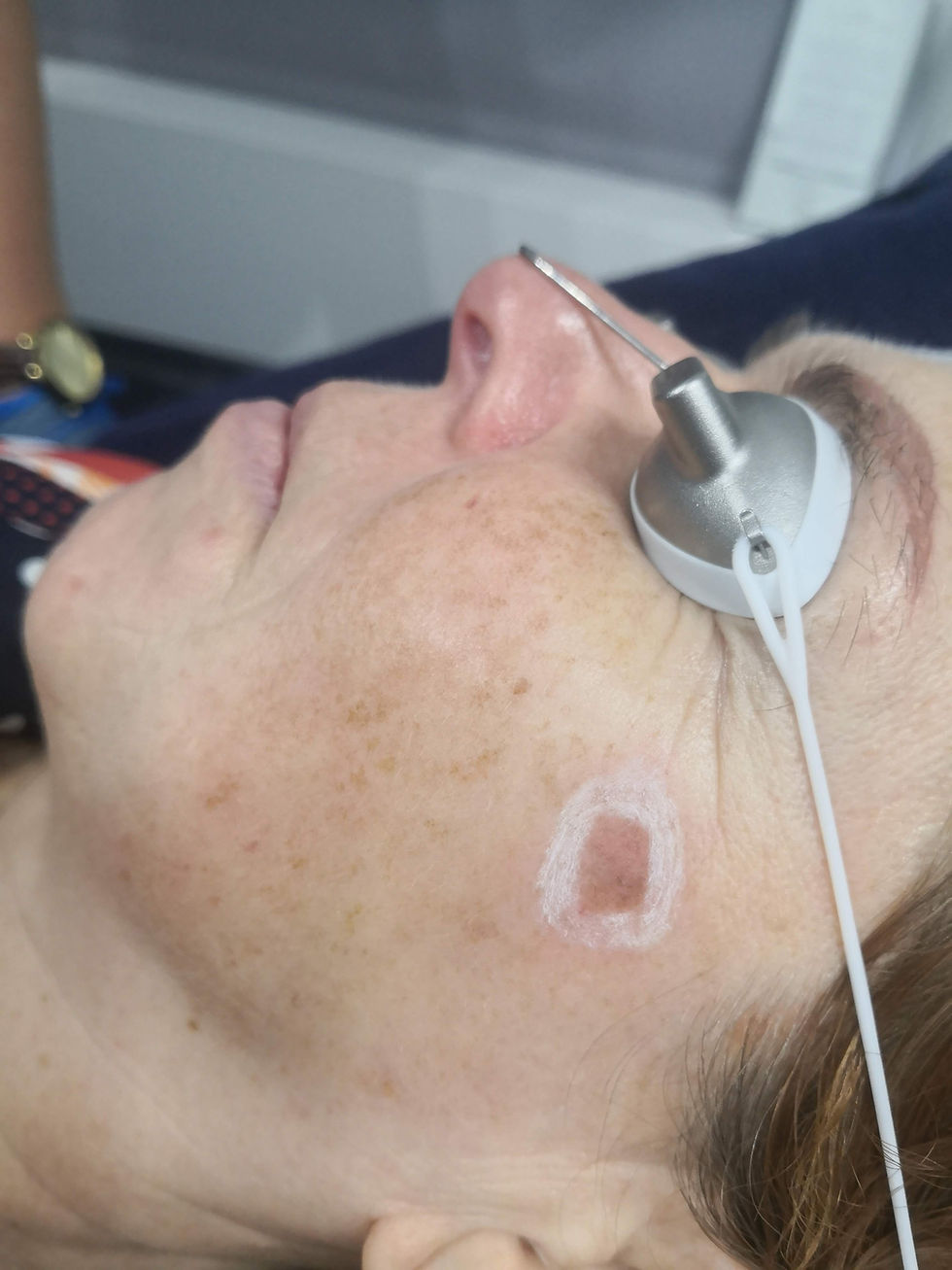 Pigmentation removal Dublin 