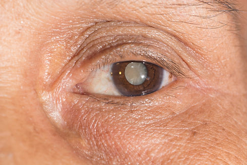 eye&I-cataract.jpeg