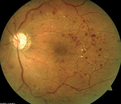 eye&I-diabetic-retinopathy.jpeg