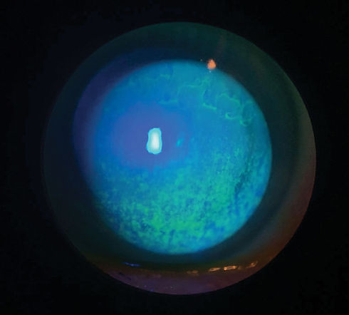 eye&I-aqueous-dry-eye.jpeg