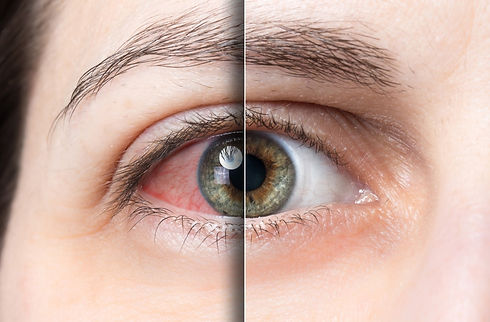 eye-before-after-dry-eye-treatment-eye&I.jpeg