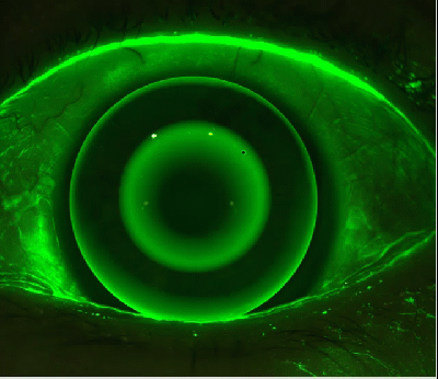 eye&I-corneal-staining-fluid-dynamics.gif