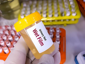 Mucus in Urine: Understanding the Signs, Causes, and Treatment