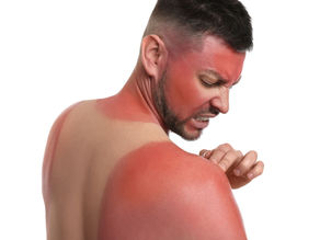 How to Stop Sunburn Itch