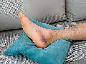 Sprain vs. Fracture: What’s the difference?