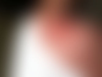 Sun Poisoning: Causes, Symptoms, and Treatment