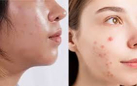 Skin care