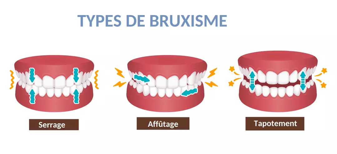 Bruxisme_grincement_dents_Divonne