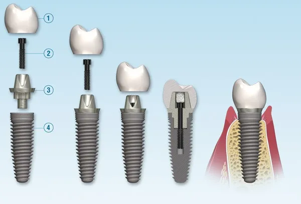 implant couronne dent dentiste divonne