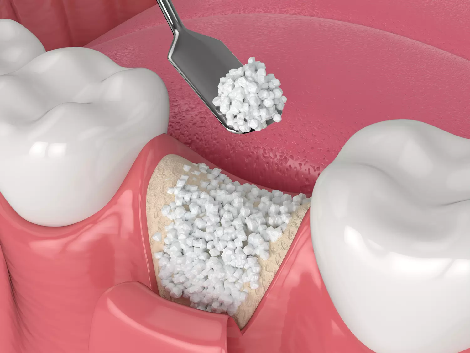Greffe_Osseuse_Implant_Divonne.webp