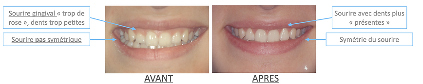chirurgie plastique parodontale sourire
