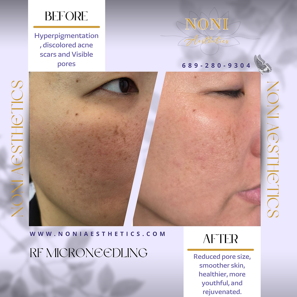 Before and after photo showing reduced hyperpigmentation, acne scars, and pores after RF Microneedling at Noni Aesthetics.