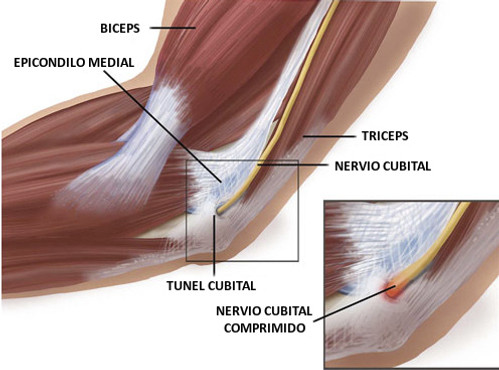 Anatomía del codo. Se visualia bíceps, epicóndilo medial, tríceps y nervio cubital comprimido en el interior del túnel cubital. 