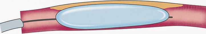 Balloon angioplasty of complex below knee disease. Oklahoma city