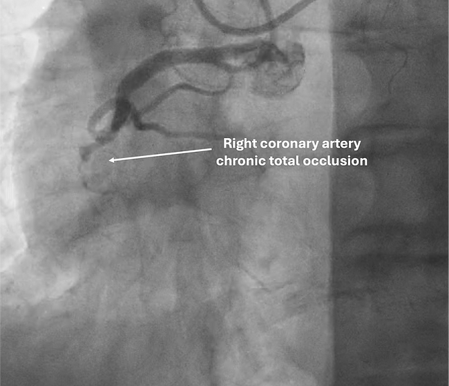 Coronary Chronic total occlusion of the right coronary artery- Oklahoma city