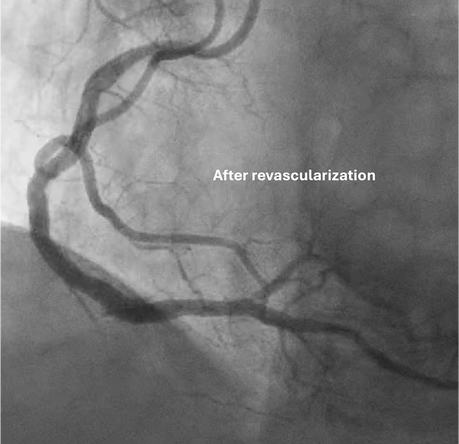 Successful revascularization of right coronary artery chronic total occlusion by Dr. Michael Megaly. Oklahoma