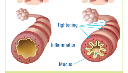 An Overview of Asthma: Definition, Symptoms, and Treatment Options