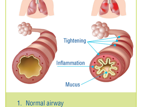 An Overview of Asthma: Definition, Symptoms, and Treatment Options