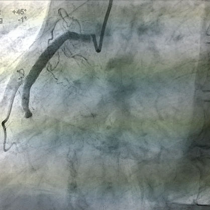 Coronaria derecha oclusion total