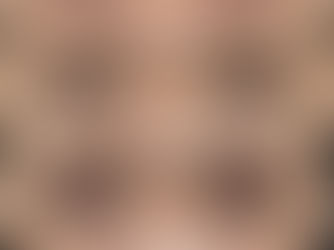 眉下リフト抜糸なし　症例写真