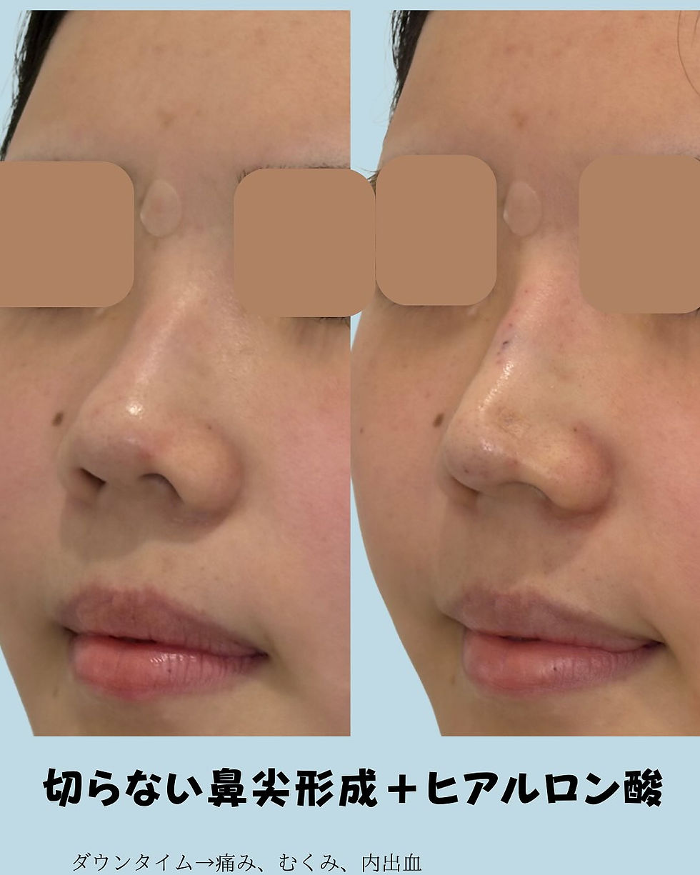 切らない鼻尖形成 × ヒアルロン酸 症例写真2
