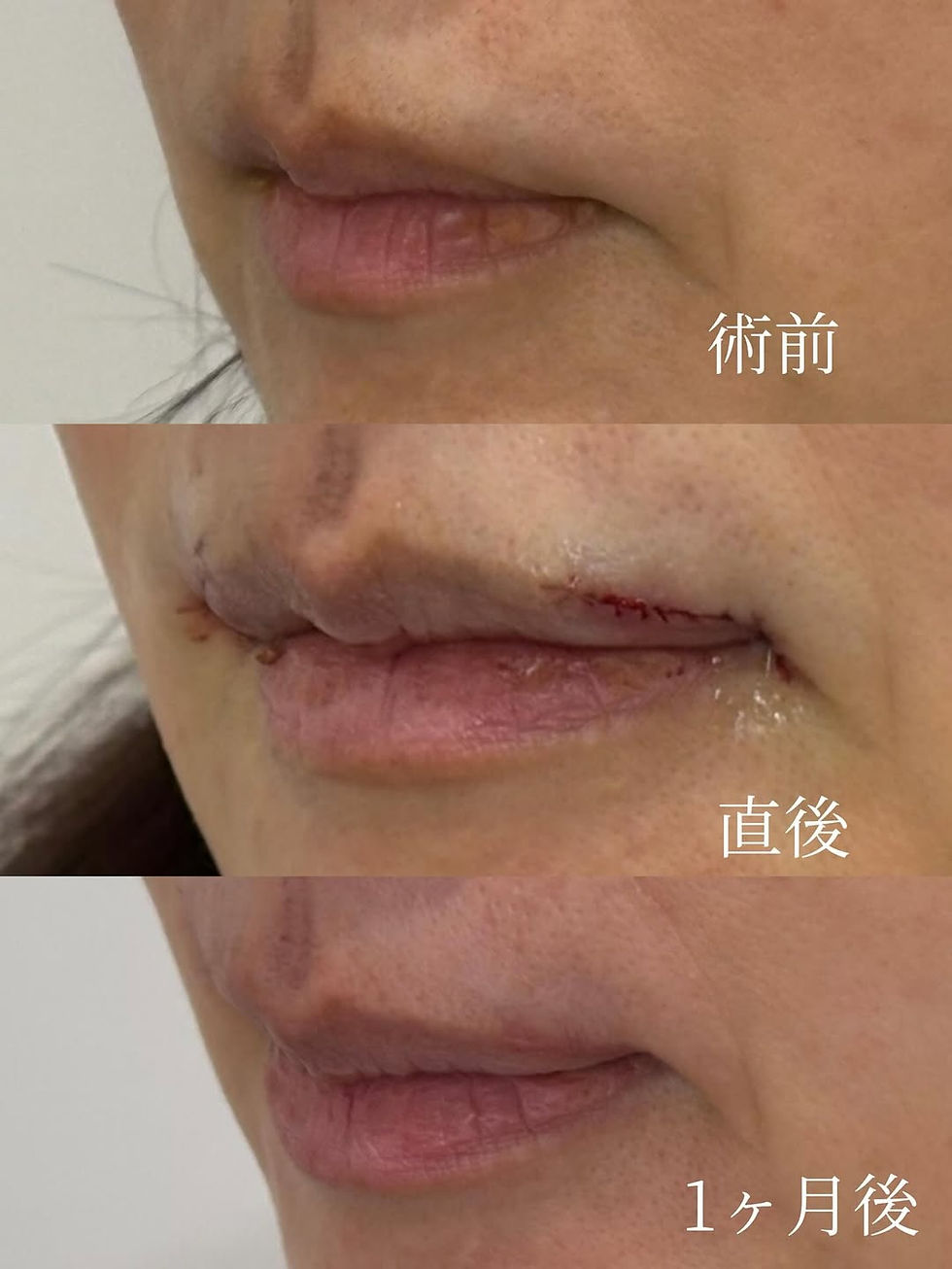 外側人中短縮 × 口角拳上 × ボツリヌストキシン注射(顔) 症例写真2