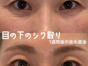 目の下のシワ取り