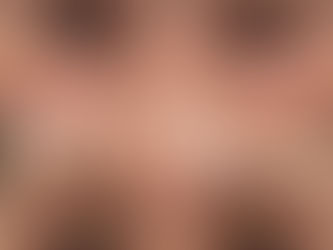 目の下のシワ取り