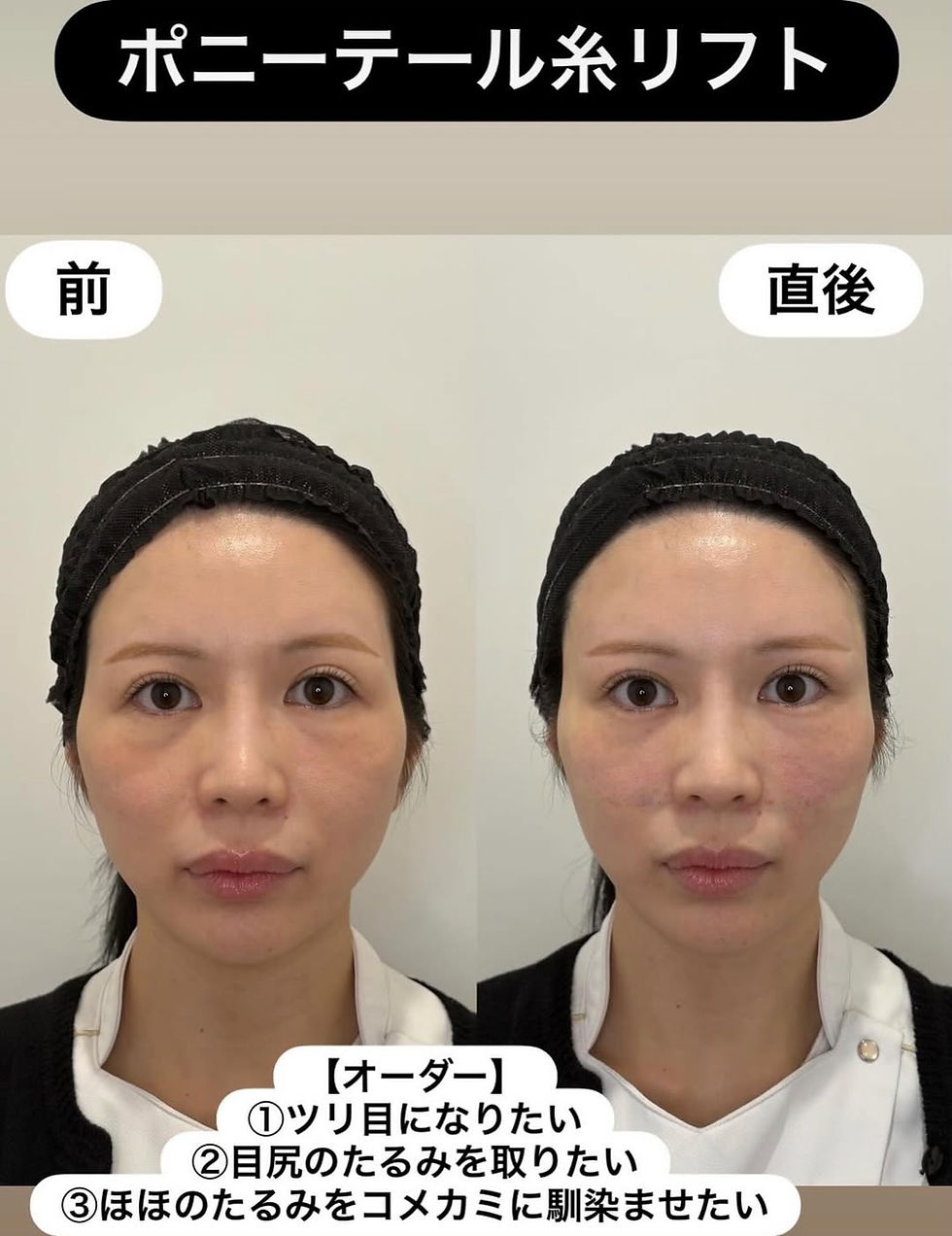 ショッピングリフト × ポニーテールリフト × 笑気麻酔 症例写真