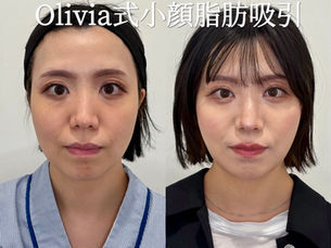 脂肪吸引(フェイス、ジョール)×Olivia Lift6本　症例写真
