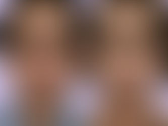 Olivia式小顔脂肪吸引 × ナゾラビアルファット除去 × Olivia Lift × ペリカンリフト 症例写真