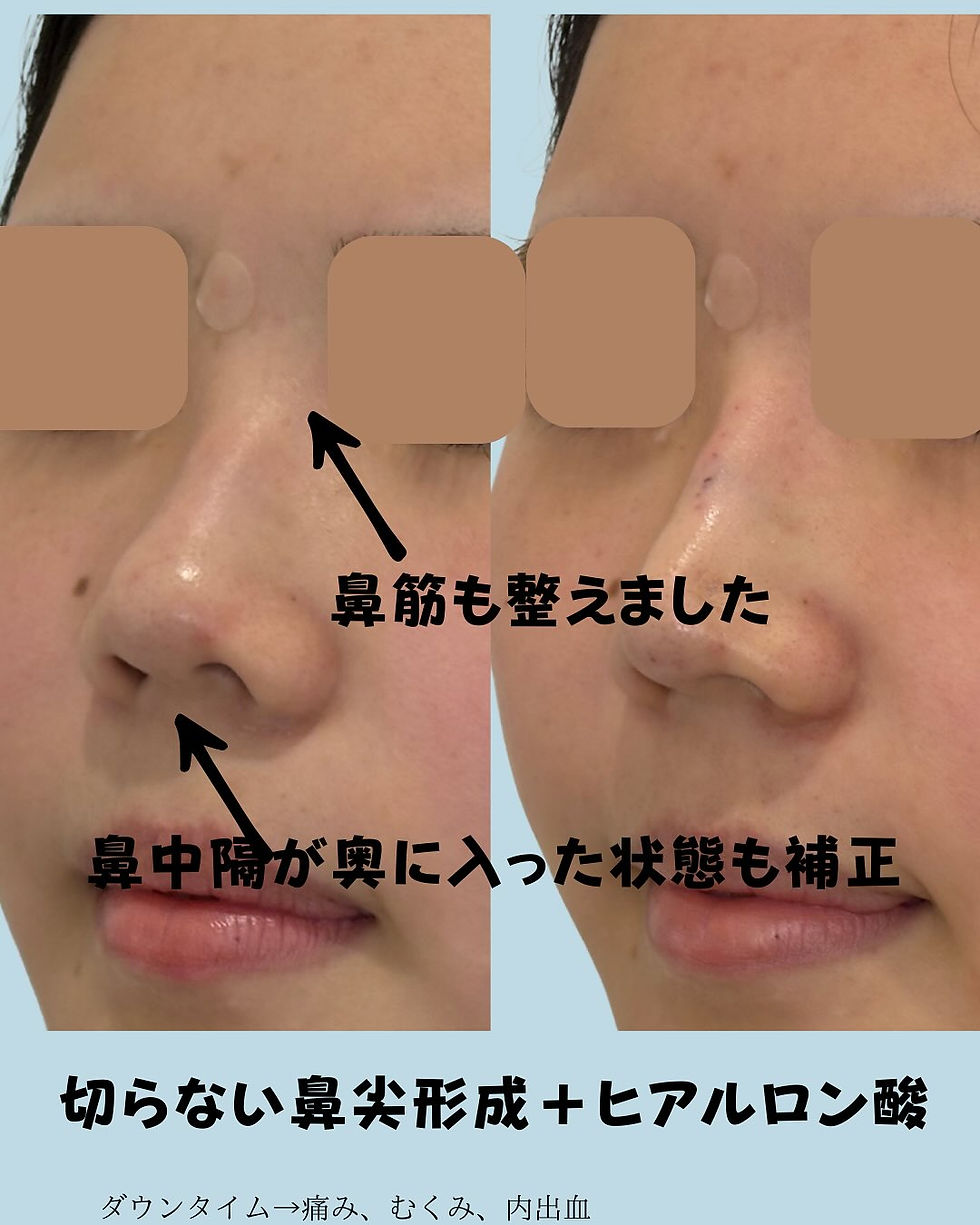 切らない鼻尖形成 × ヒアルロン酸 症例写真3