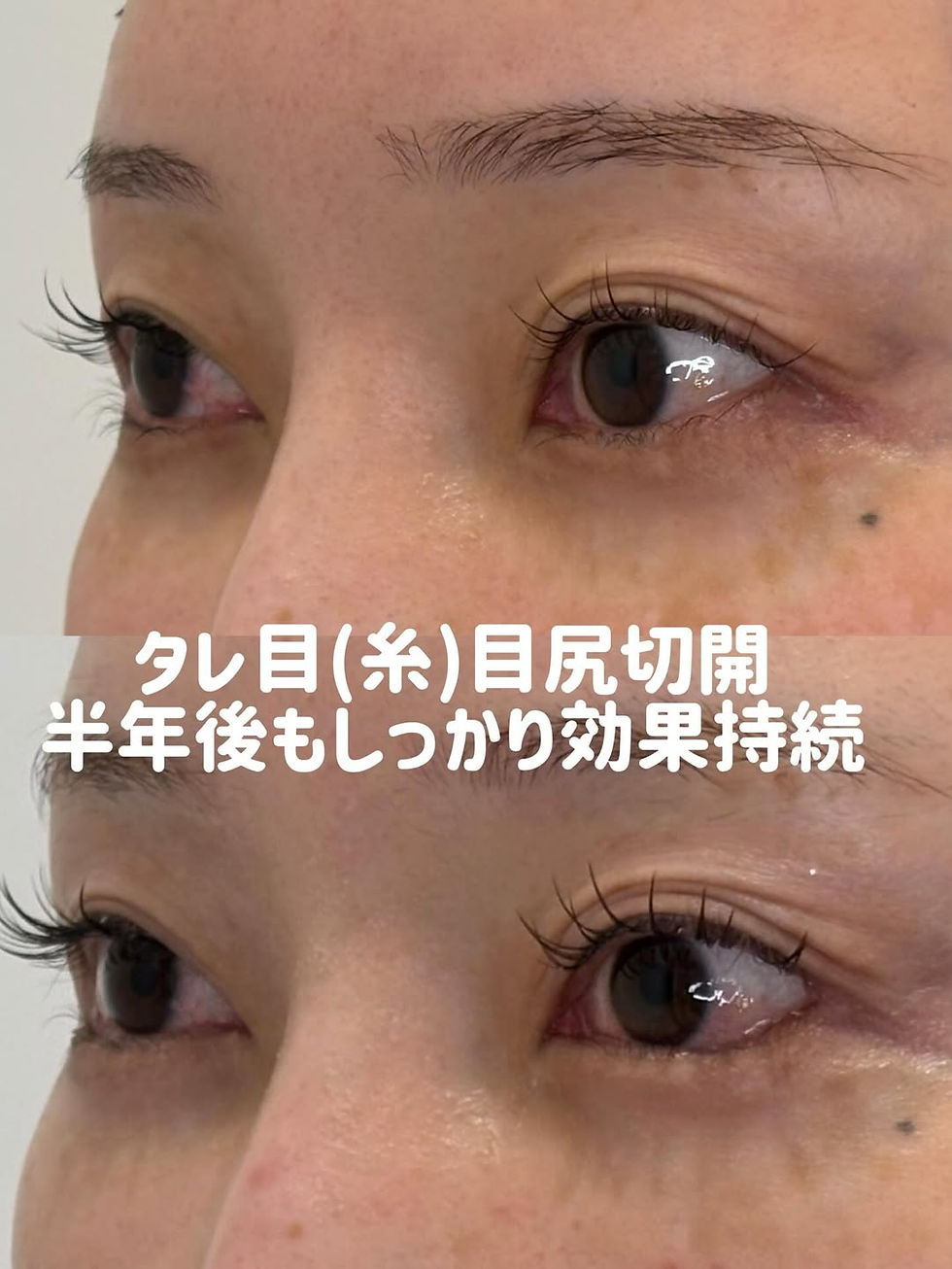 タレ目形成 × 目尻切開 症例写真2