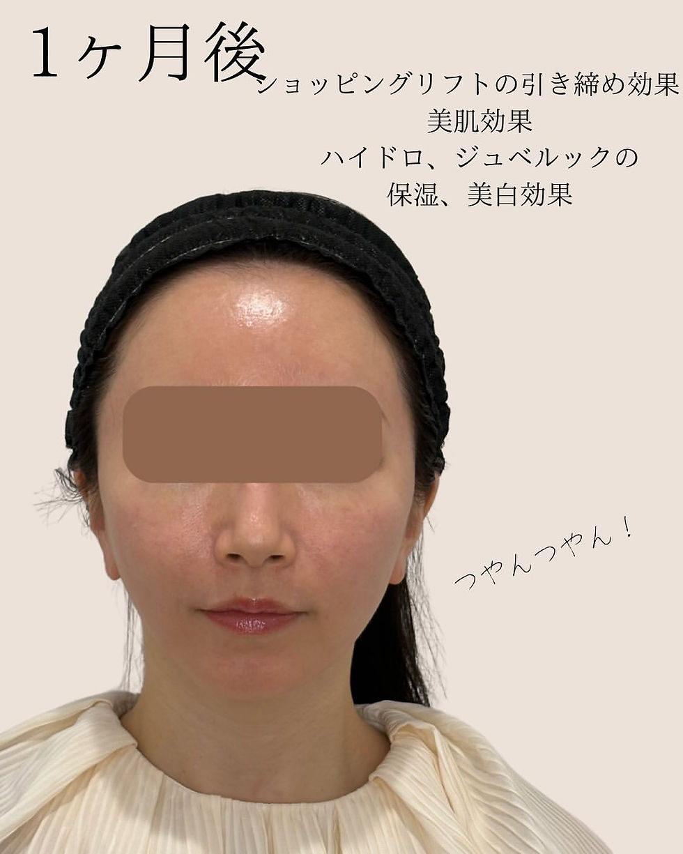 手打ち水光注射 × ビタミンCショッピングリフト 症例写真3