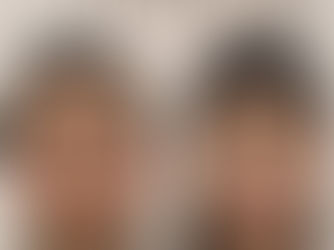 ナゾラビアルファット除去 × 顔の横幅縮小　症例写真