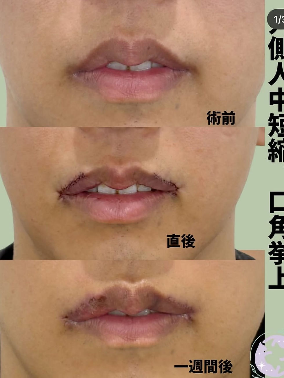 外側人中短縮 × 口角拳上 × ボツリヌストキシン注射(顔) 症例写真5