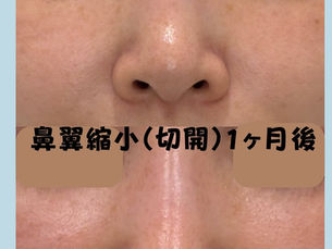 鼻翼縮小　症例写真