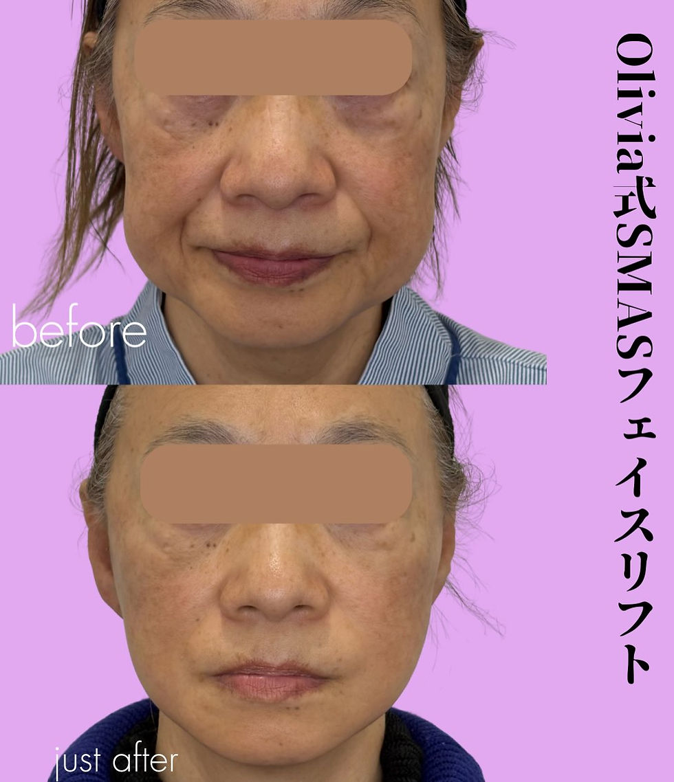 Olivia式SMASフェイスリフト 症例写真2