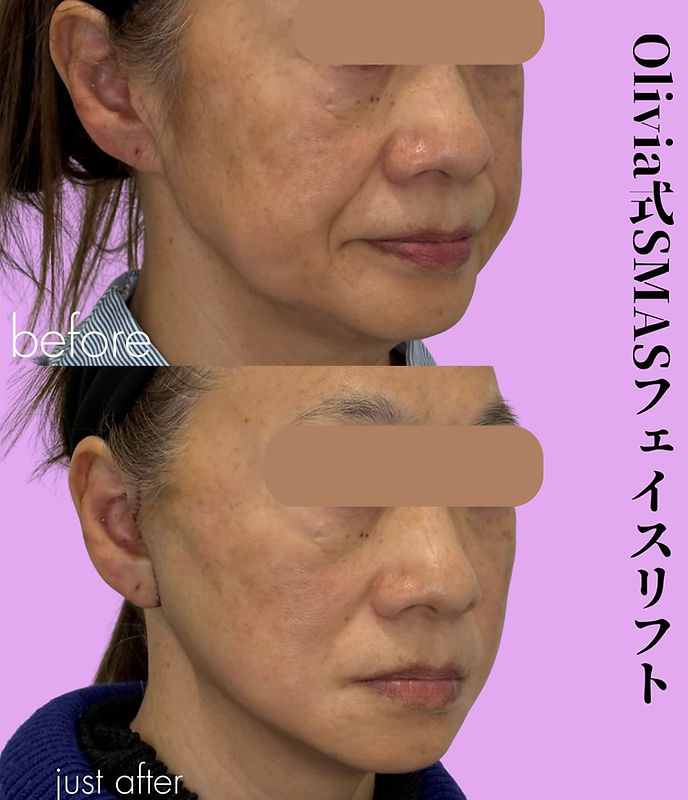 ELAICE フェイスリフト 症例: Olivia式SMASフェイスリフト | Olivia Clinic