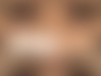 タレ目形成 × 目尻切開(男性) 症例写真